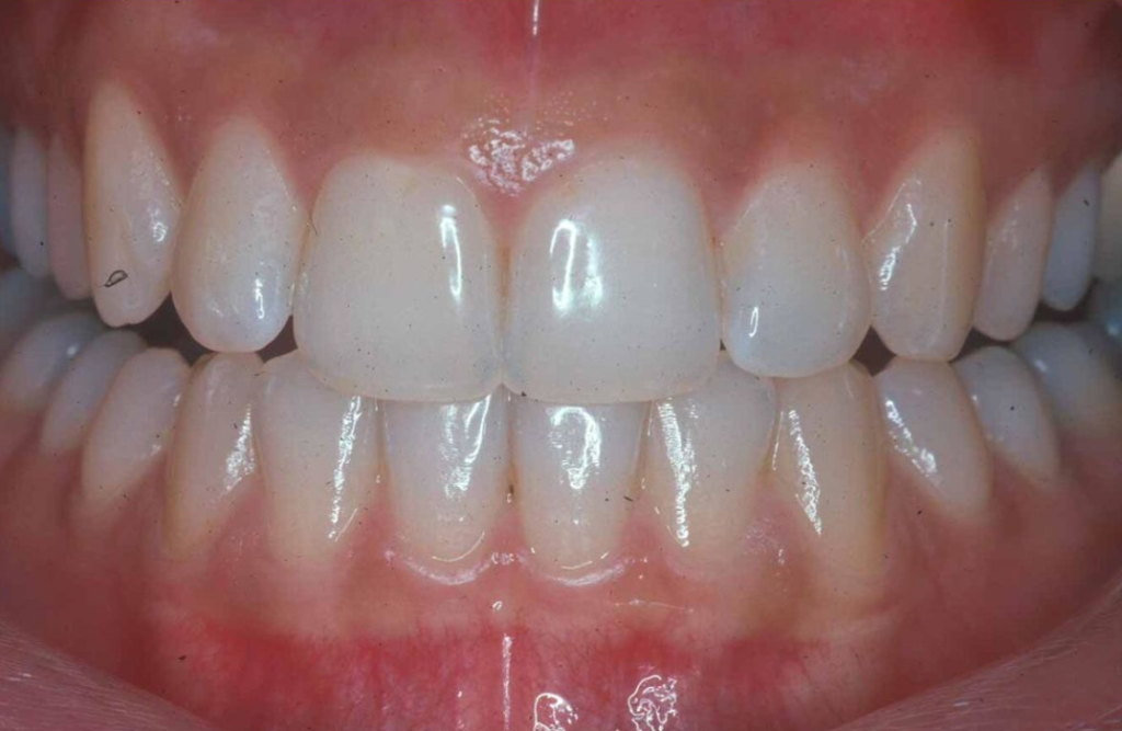 How to maintain a healthy gums or gingiva
