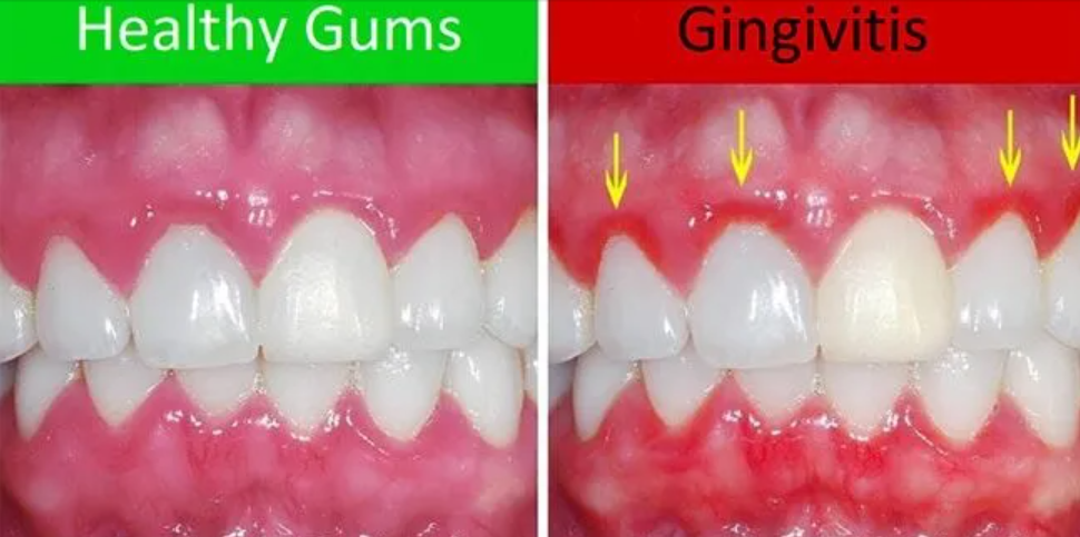 How to maintain a healthy gums or gingiva